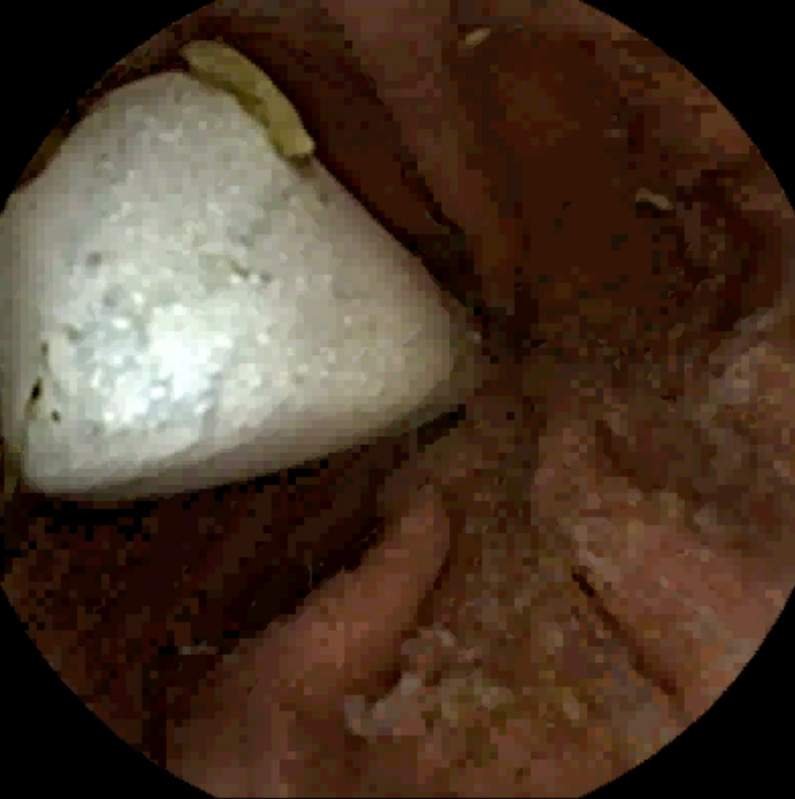 The documentary of the bluetooth – video still of one of the rare moments the Bluetooth was spotted by the PillCam, recording of 8.30 h, 2013